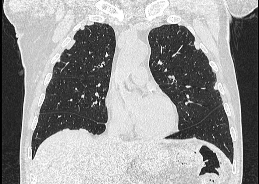 Asbestos pleural placques (Radiopaedia 57905-64872 Coronal lung window 110).jpg
