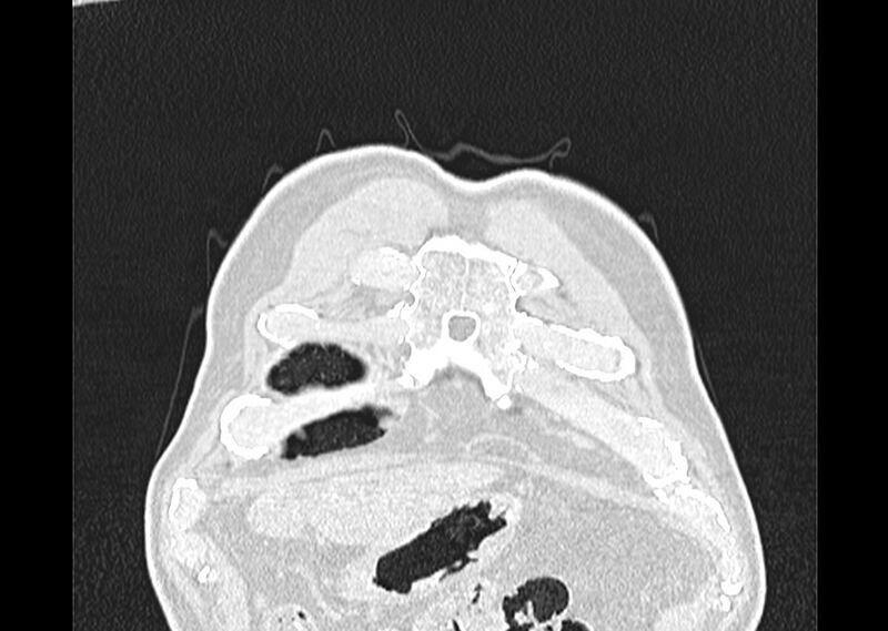 File:Asbestos pleural placques (Radiopaedia 57905-64872 Coronal lung window 8).jpg