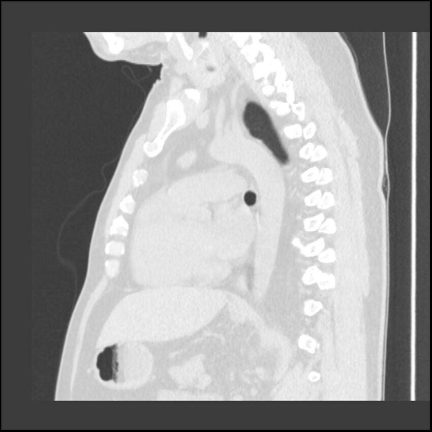 Asbestosis (Radiopaedia 45002-48961 Sagittal lung window 58).jpg