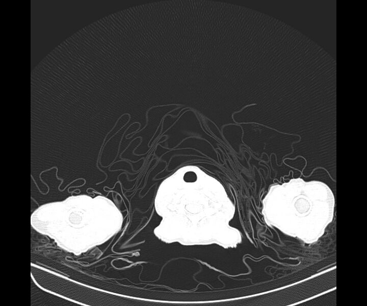 File:Aspergillomas (Radiopaedia 66779-76110 Axial lung window 3).jpg
