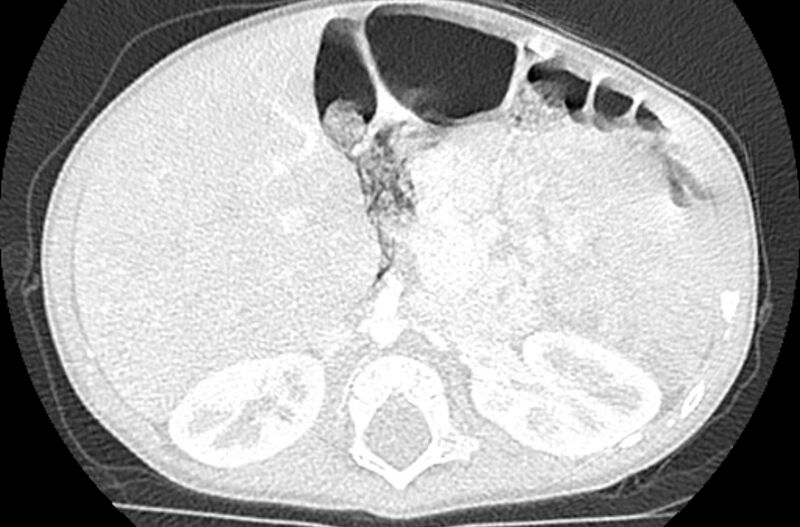 File:Asplenia syndrome (Radiopaedia 73083-83792 Axial lung window 87).jpg