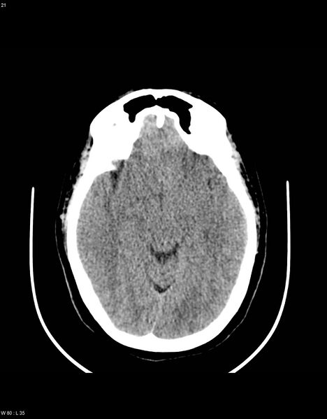File:Astroblastoma (Radiopaedia 39792-42216 Axial non-contrast 20).jpg