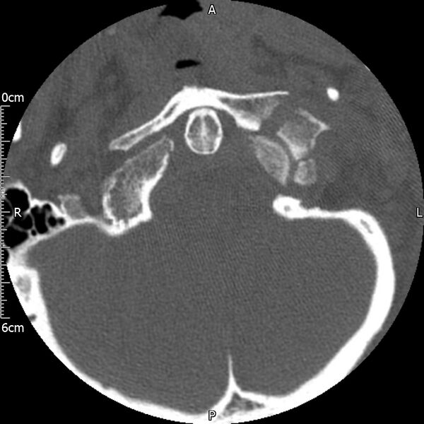 File:Atlas fracture with Currarino type A congenital defect (Radiopaedia 71747-82144 Axial bone window 23).jpg