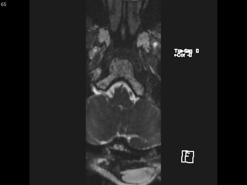 File:Atypical meningioma - intraosseous (Radiopaedia 64915-74572 Axial CISS 65).jpg
