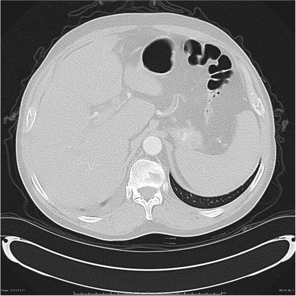 File:Atypical pneumonia - Q fever (Radiopaedia 21993-21989 lung window 48).jpg