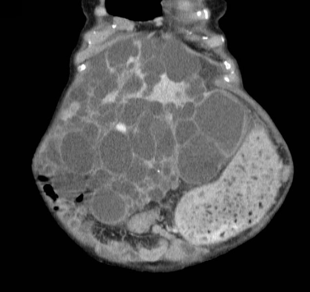 File:Autosomal dominant polycystic kidney disease (Radiopaedia 16777-16490 B 6).jpg