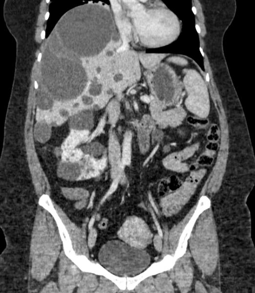 File:Autosomal dominant polycystic kidney disease (Radiopaedia 57124-64017 B 37).jpg