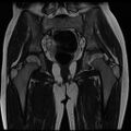 Avascular necrosis of the hip (Radiopaedia 29563-30067 Coronal T2 10).jpg