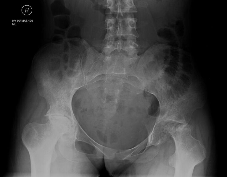 File:Avascular necrosis of the hip - bilateral (Radiopaedia 13760).jpg