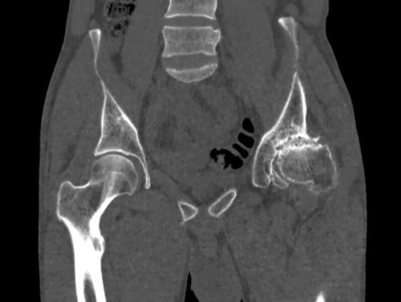 File:Avascular necrosis of the left hip (Radiopaedia 75068-86125 Coronal bone window 24).jpg