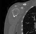 Avulsion fracture - greater tuberosity of humerus (Radiopaedia 71216-81514 Coronal bone window 17).jpg