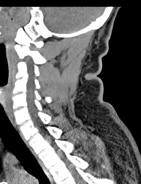 File:Axis peg fracture (type 3) and atlas lateral mass (type 4) fracture (Radiopaedia 37474-39324 D 44).png