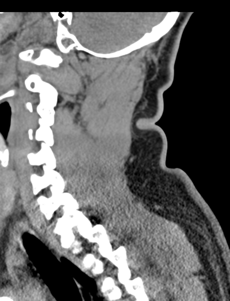 File:Axis peg fracture (type 3) and atlas lateral mass (type 4) fracture (Radiopaedia 37474-39324 D 50).png