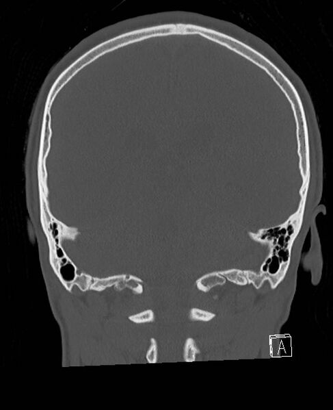File:Base of skull fracture with bilateral Le Fort fractures (Radiopaedia 47094-51638 Coronal bone window 33).jpg