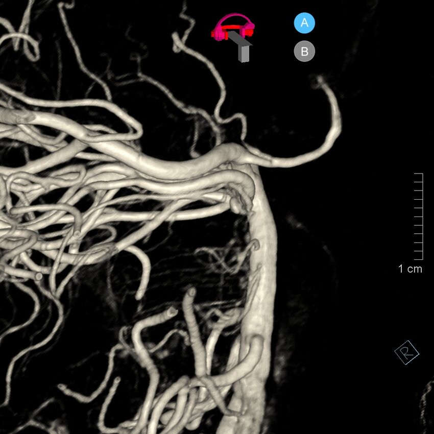 Basilar artery perforator aneurysm (Radiopaedia 82455-97734 3D view left VA 136).jpg