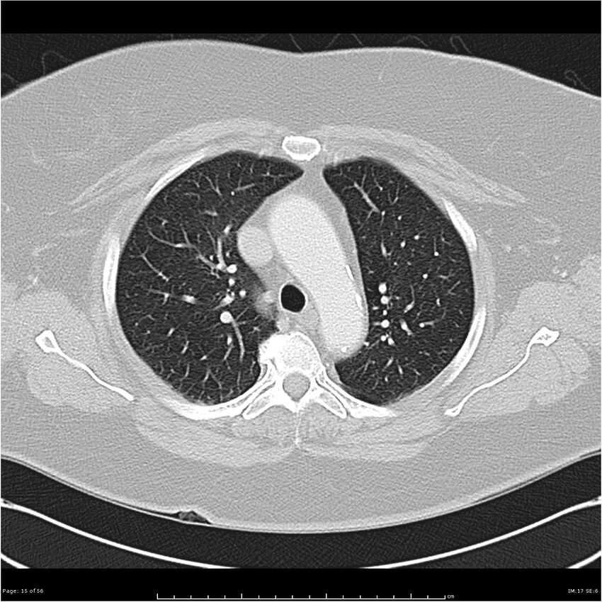 Benign metastasizing leiomyoma (Radiopaedia 26803-26962 Axial lung window 15).jpg
