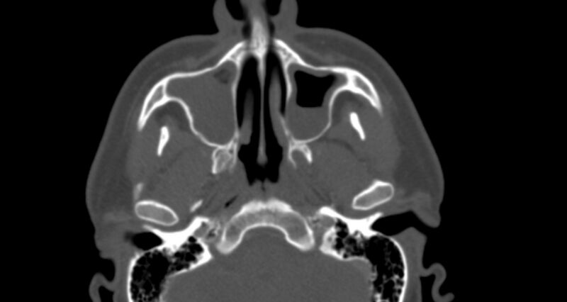 File:Benign mixed salivary tumor of the parotid gland (Radiopaedia 35261-36792 Axial bone window 10).jpg