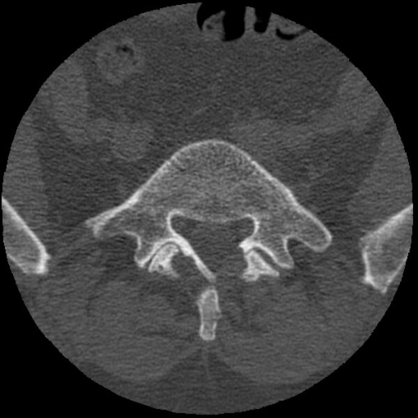 File:Bertolotti syndrome (Radiopaedia 24864-25128 Axial bone window 8).jpg