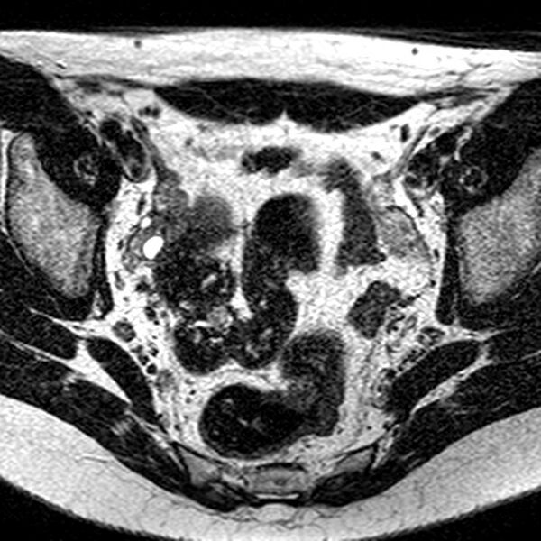 File:Bicornuate uterus (Radiopaedia 11104-11492 Axial T2 25).jpg
