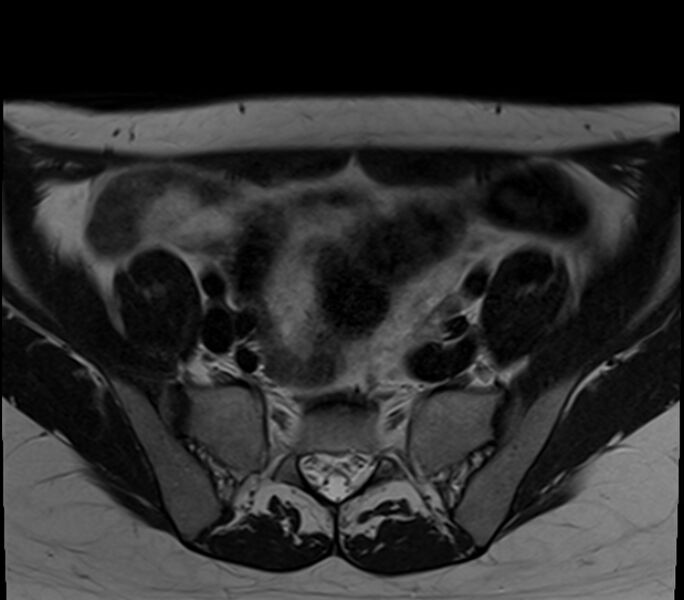File:Bicornuate uterus (Radiopaedia 71214-81511 Axial T2 28).jpg
