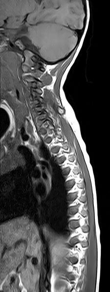 File:Bilateral Sprengel deformity with Klippel-Feil syndrome (Radiopaedia 66395-75650 Sagittal T1 3).jpg