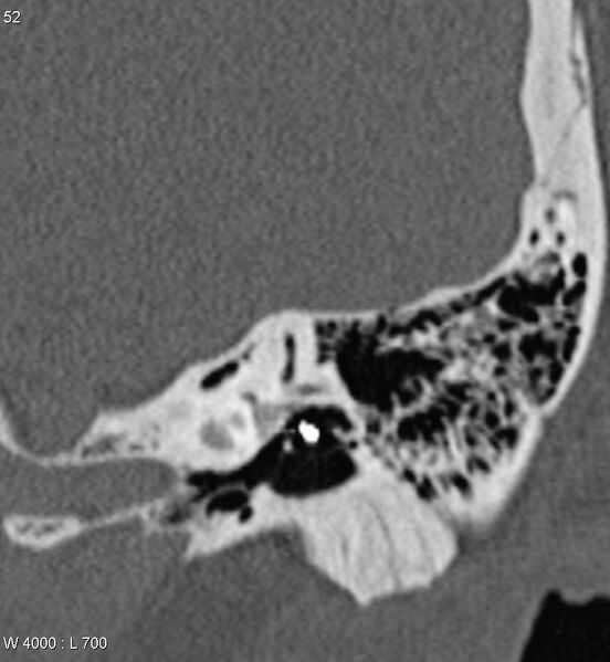 File:Bilateral otosclerosis with left stapes prosthesis (Radiopaedia 5567-7302 D 4).jpg