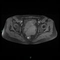 Bilateral ovarian fibroma (Radiopaedia 44568-48293 Axial T1 fat sat 18).jpg