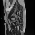 Bilateral ovarian fibroma (Radiopaedia 44568-48293 Sagittal T2 1).jpg