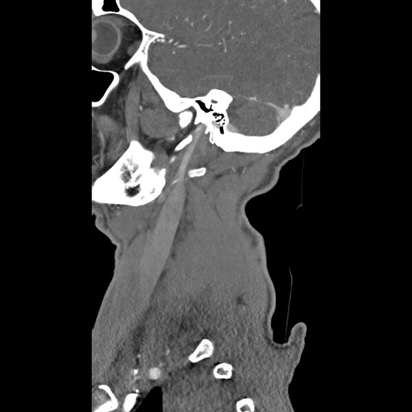 File:Bilateral perched facets with cord injury (Radiopaedia 45587-49713 B 3).jpg
