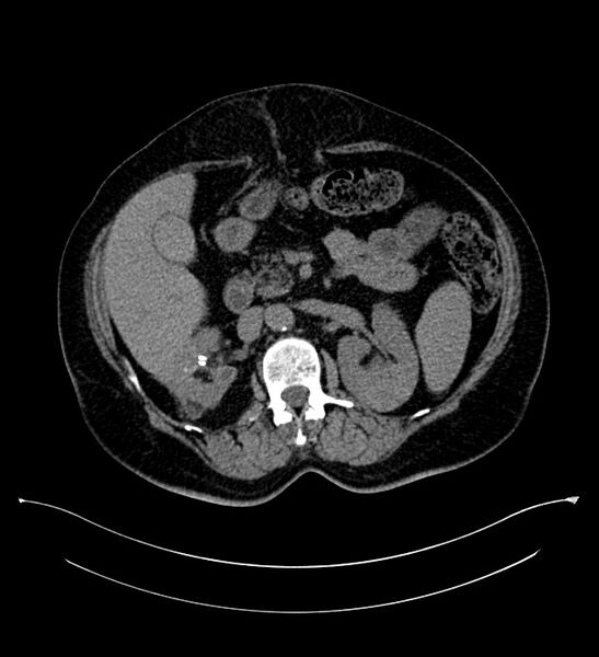 File:Bilateral sporadic synchronous clear cell renal cell carcinoma (Radiopaedia 85035-100575 Axial non-contrast 41).jpg