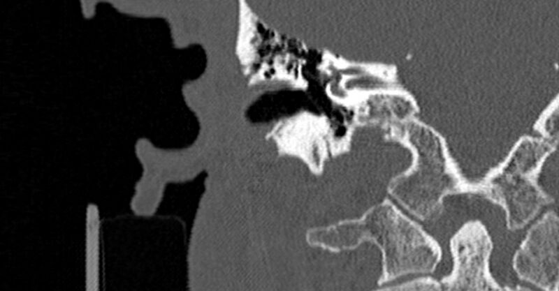 File:Bilateral temporal bone fractures (Radiopaedia 29482-29970 Coronal non-contrast 107).jpg