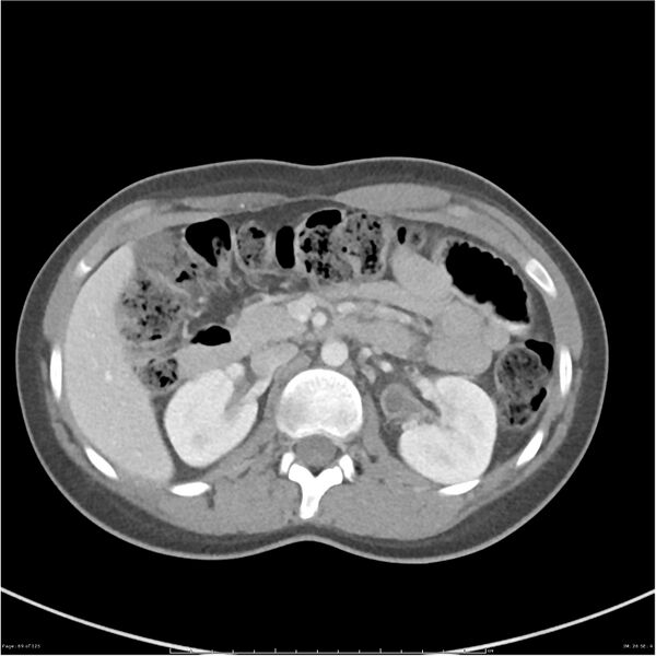 File:Bilateral ureteritis and cystitis (Radiopaedia 25340-25594 A 26).jpg