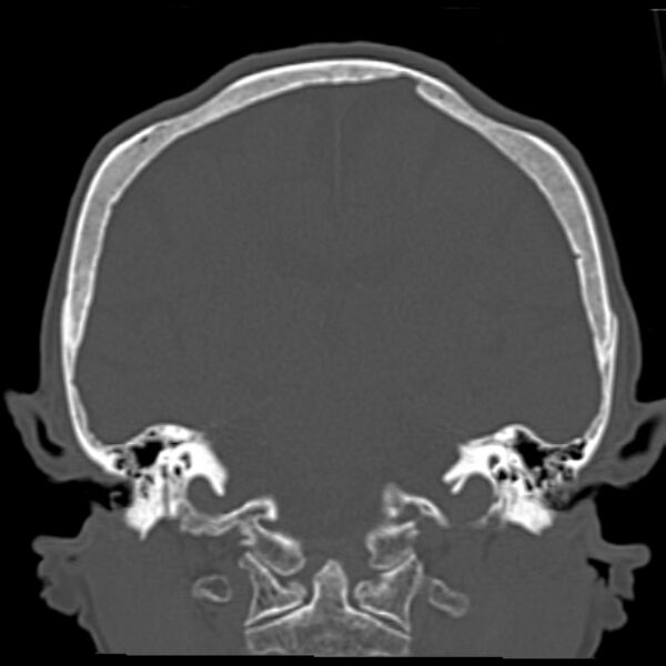 File:Biparietal osteodystrophy (Radiopaedia 46109-50463 Coronal bone window 63).jpg