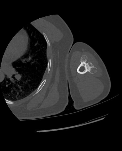File:Bizarre parosteal osteochondromatous proliferation (Radiopaedia 84221-99501 Axial bone window 96).jpg