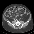 Bladder papillary urothelial carcinoma (Radiopaedia 48119-52951 Axial 36).png