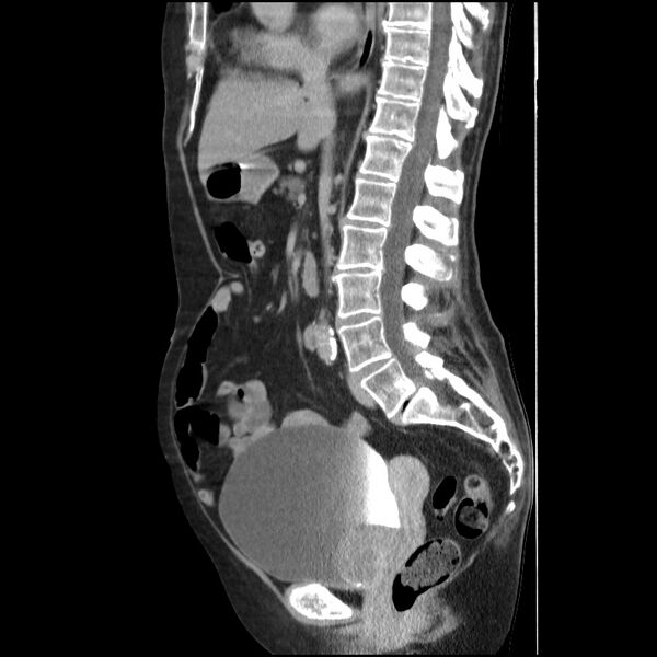 File:Bladder tumor detected on trauma CT (Radiopaedia 51809-57609 E 37).jpg