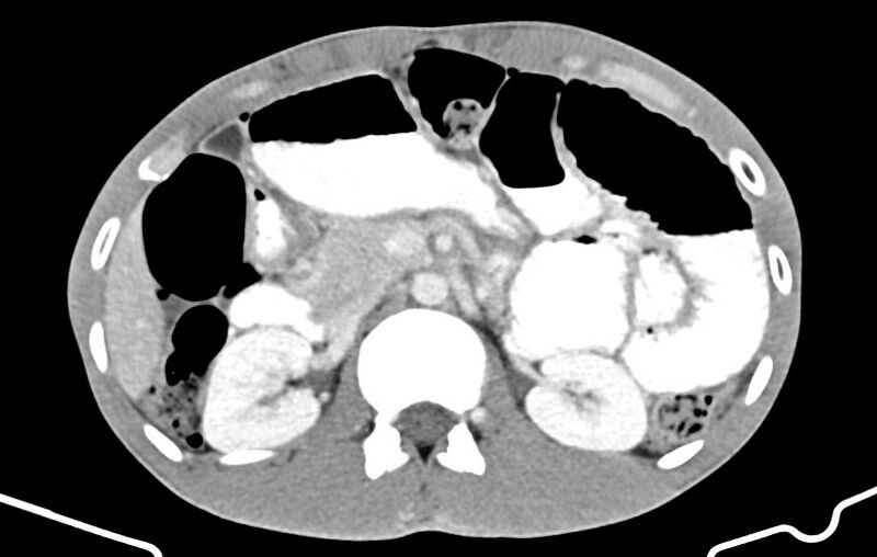 File:Blunt injury to the small bowel (Radiopaedia 74953-85987 A 57).jpg