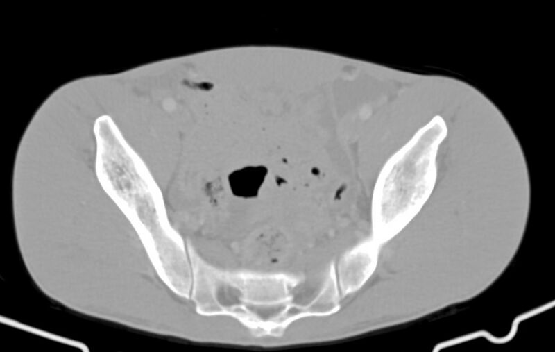 File:Blunt injury to the small bowel (Radiopaedia 74953-85987 Axial Wide 82).jpg