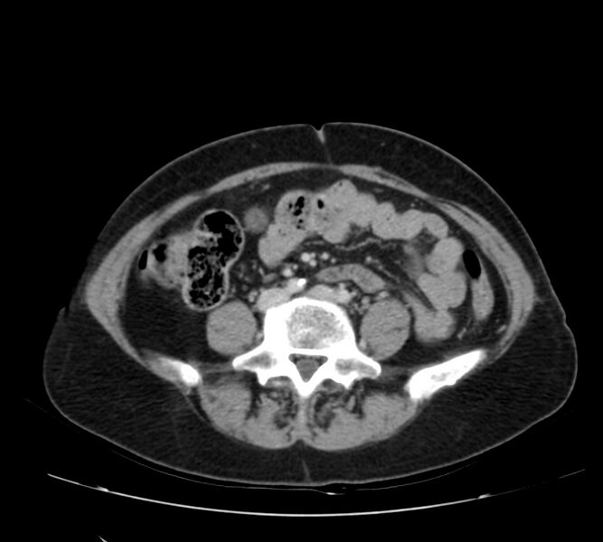 File:Bosniak renal cyst - type IV (Radiopaedia 22929-22953 C 41).jpg