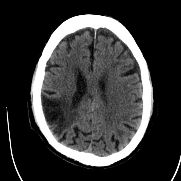 File:Brain Pantopaque remnants (Radiopaedia 78403-91048 Axial non-contrast 61).jpg