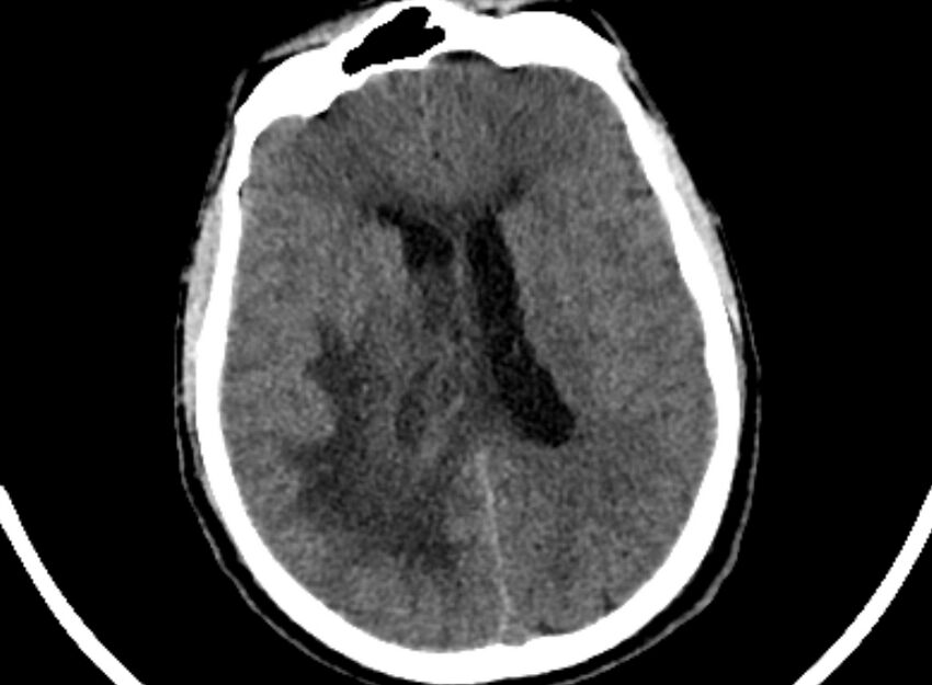 Brain abscess complicated by intraventricular rupture and ventriculitis (Radiopaedia 82434-96575 Axial non-contrast 58).jpg
