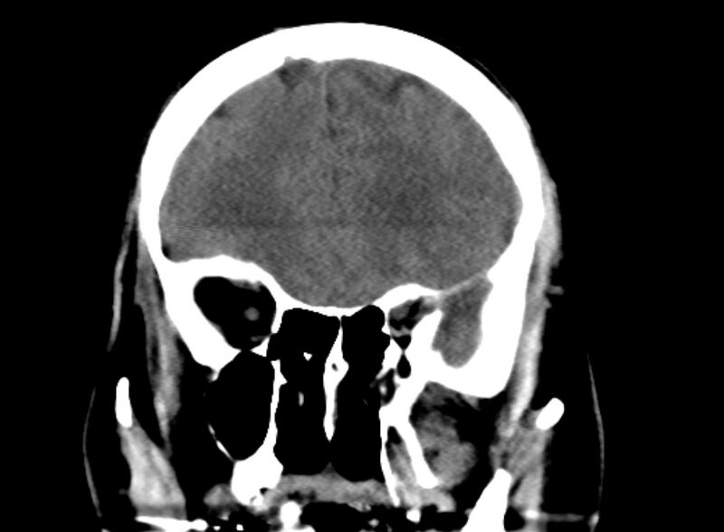File:Brain abscess complicated by intraventricular rupture and ventriculitis (Radiopaedia 82434-96575 Coronal non-contrast 4).jpg