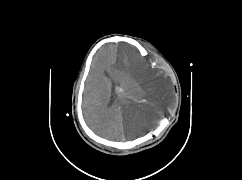 File:Brain injury by firearm projectile (Radiopaedia 82068-96087 B 122).jpg