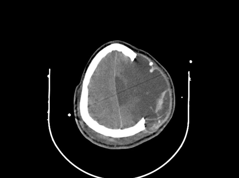 File:Brain injury by firearm projectile (Radiopaedia 82068-96087 B 148).jpg