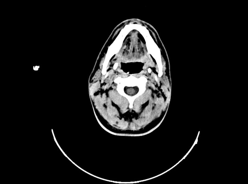 File:Brain injury by firearm projectile (Radiopaedia 82068-96088 A 40).jpg