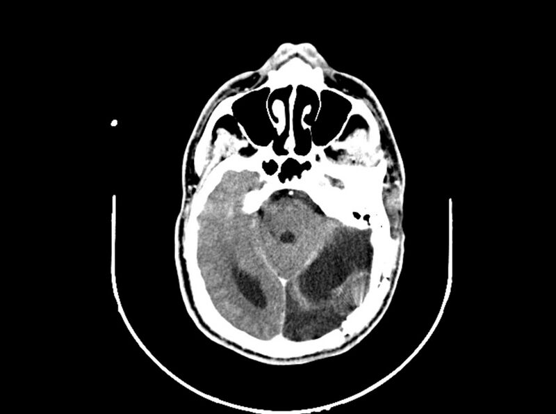 File:Brain injury by firearm projectile (Radiopaedia 82068-96088 B 98).jpg
