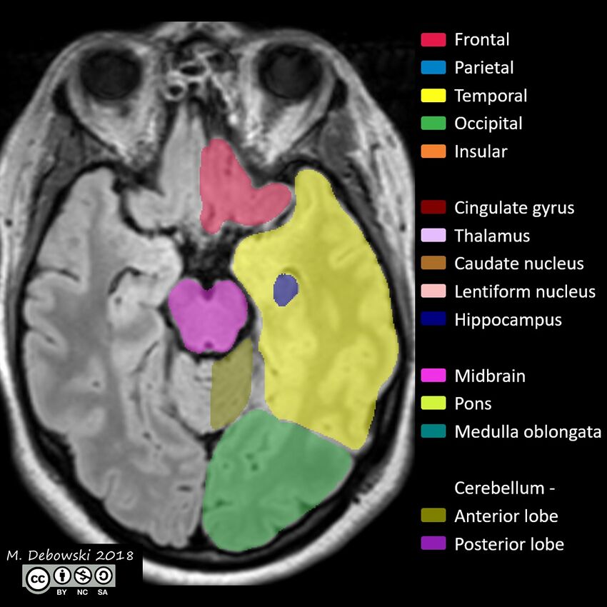 Brain lobes - annotated MRI (Radiopaedia 61691-69700 Axial 49).JPG