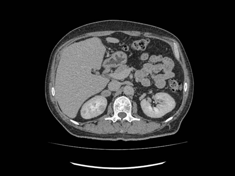 File:Brain metastases from renal cell carcinoma (Radiopaedia 42222-45328 Axial C+ delayed 58).jpg