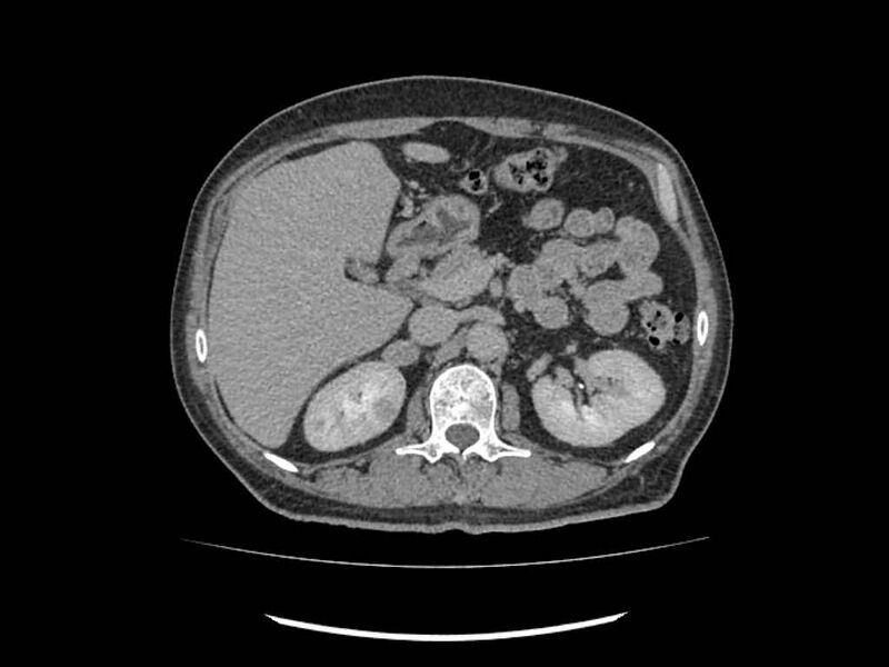 File:Brain metastases from renal cell carcinoma (Radiopaedia 42222-45328 Axial C+ delayed 59).jpg