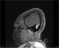Brainstem glioma (Radiopaedia 21819-21775 D 3).jpg